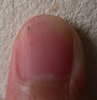 爪の中に突然 痛い黒いとげ が出現 その原因が判明 たびいちドットコム