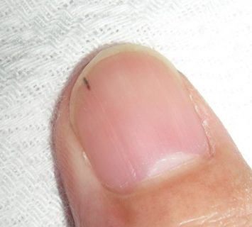 爪の中に突然 痛い黒いとげ が出現 その原因が判明 たびいちドットコム